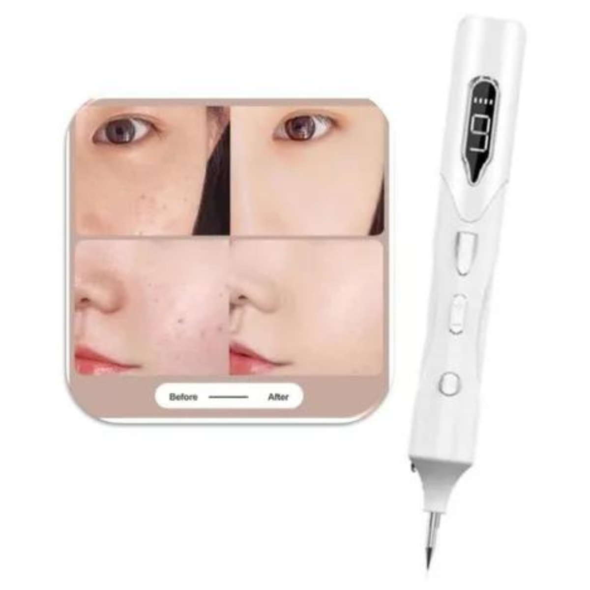 Plasma Pen - Lápiz Plasma Cauterizador Recargable