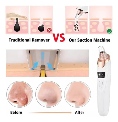 Limpiador Puntos Negros Cleaner - Tecnología de Succión